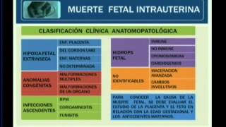 MUERTE FETAL INTRAUTERINA [upl. by Enileda]