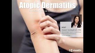 Atopic Dermatitis VisualDx Clinical Education Series [upl. by Ermey426]