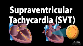 Supraventricular Tachycardia SVT PSVT Animation [upl. by Wemolohtrab]