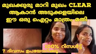 മുഖക്കുരു മാറാൻ അടുക്കളയിലെ ഈ ഒരു ഐറ്റം മാത്രം മതി  Mystyle with Jesna [upl. by Anelrahs]