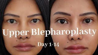 Upper Blepharoplasty recovery hooded eye day 114 Vlog [upl. by Annaesor]