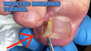 INFECTED INGROWN TOENAIL treatment at home how to cut and remove ingrown Pain relief by Podiatrist [upl. by Ruenhcs385]