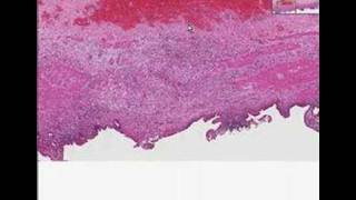 Histopathology GallbladderChronic cholecystitis [upl. by Prosser]