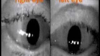 Eye Movevement Examples [upl. by Deborath]