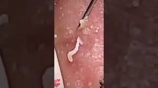 Skincare  Blackheads Removal 217 squeeze squeeze blackheads blackheads [upl. by Suzann]