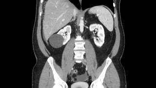 Pseudomembranous colitis  C Difficil colitis  coronal CT reformat [upl. by Eibrad937]