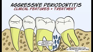 Aggressive Periodontitis Part 2  Clinical features and treatment [upl. by Renata]