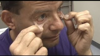 Cosmetic Eyelid Surgery Upper And Lower Blepharoplasty Part 1 [upl. by Arriek]