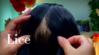 ASMR Scalp Check Lice Removal Sleep Recovery  No Talking 🥱😴💤 [upl. by Nawad]