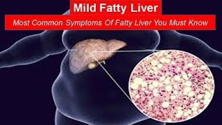 Mild Fatty Liver Most Common Symptoms Of Fatty Liver You Must Know [upl. by Ahcsap]