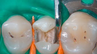 DRendo  Nonselective caries excavation the only correct clinical approach [upl. by Rakia290]