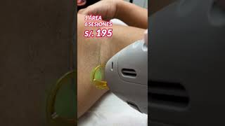 Aprovecha está Promoción en depilación de axilas con láser belleza depilacionlaser hairremoval [upl. by Llenrrad]