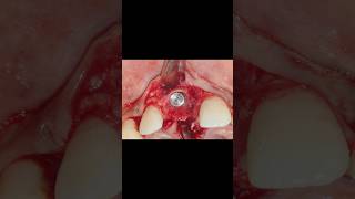 Immediate Implant placement  Luxator extraction Osseodensification  Bone Grafting PERIO SUBHARTI [upl. by Leahcimauhsoj360]