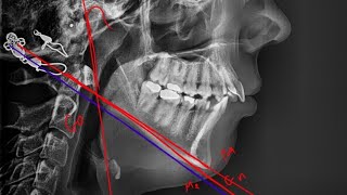 07 Utilization of Mandibular Plane Cephalometric analysis [upl. by Phemia]