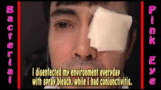 Severe Bacterial Pink Eye Conjunctivitis treatment part 7 [upl. by Sapienza]