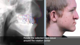 Treatment planning and soft tissue prediction 9 with Facad software [upl. by Atiuqat]