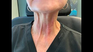 Injecting Botox in the Neck to relax neck bands [upl. by Scevor]