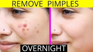 How To Remove Pimples Overnight  Acne Treatment  Anaysa [upl. by Clayborn]