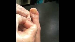 Draining a Subungual blister of toenail [upl. by Bove103]