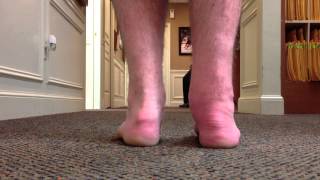 Gait after Arthroscopic Ankle Fusion SFISM [upl. by Meehyrb465]