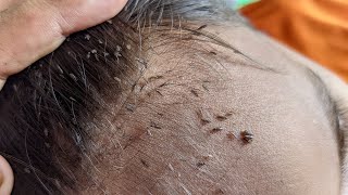 Remove all big lice from his hair  How to remove all hundred lice from his head [upl. by Jahdol]