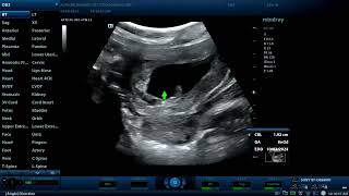 Non viable embryo with retroplacental hematoma Diagnostic ultrasound cases [upl. by Cerelly]