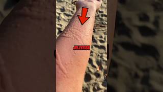 How To Survive a Jellyfish Sting 😨 [upl. by Abernathy554]