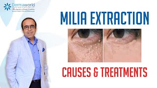 Milia Extraction Causes and Treatment  Milia under the eyes  Dr Rohit Batra [upl. by Nylahsoj29]