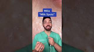 MILIA TREATMENT  DERMDOCTOR shorts [upl. by Eenafets745]