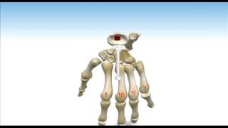 ReMotion™ Total Wrist Arthroplasty  Animated Surgical Technique [upl. by Orelle]