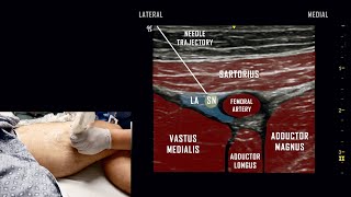 Adductor Canal Block  Ultrasound Anatomy Review [upl. by Neeham183]