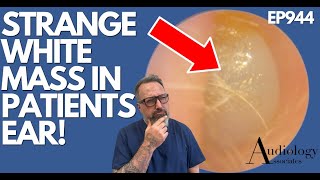 WHAT IS THIS STRANGE WHITE MASS IN PATIENTS EAR  EP944 [upl. by Woodring]