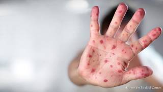 Washington state faces measles outbreak [upl. by Penney802]