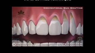 Pinhole Surgical Technique for treatment of receding gums [upl. by Naga361]