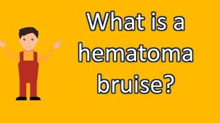 What is a hematoma bruise  Find Health Questions  Best Health TIPS [upl. by Eustasius794]