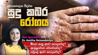 සුදු කබර රෝගය ගැන හරියට දැනගමු  All about Vitiligo  Skin Specialist [upl. by Cleti]