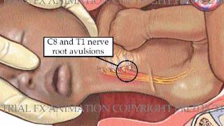 Posterior Shoulder Dystocia Animation [upl. by Norod]