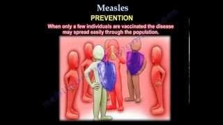 Measles  Everything You Need To Know  Dr Nabil Ebraheim [upl. by Petr]