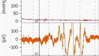 Bupivacaine Cardiotoxicity in an Anesthetized Rat [upl. by Annek212]