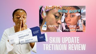 UPDATED ACNE JOURNEY  TRETINOIN REVIEW 📣 [upl. by Ahsikahs179]