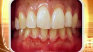 WaterLase gum depigmentation [upl. by Able]