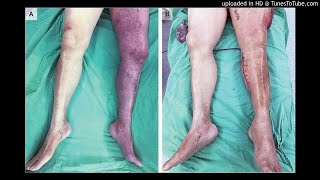 Phlegmasia Cerulea Dolens with Compartment Syndrome [upl. by Berne72]