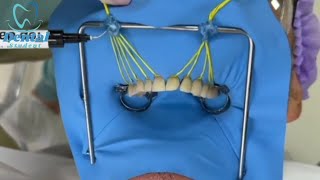 Rubber Dam placement for anterior teeth بكل سهوله [upl. by Tnahsin991]