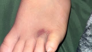 Broken toe goal [upl. by Marilou]