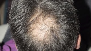 This is how stress affects hair loss [upl. by Viradis]