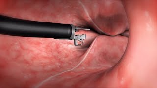 What Happens During the Endoscopic Sleeve Gastroplasty ESG Procedure [upl. by Zack]