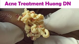 Acne Treatment Huong Da Nang  2024 Acne Huong 715 [upl. by Noiek]