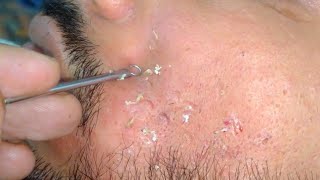 blackheads removal new video  sac dep spa blackheads removal  relaxing face treatments sac dep spa [upl. by Eniruam137]