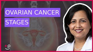 The 4 Stages of Ovarian Cancer by Dr Ruchi Garg [upl. by Tripp44]