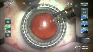 London Vision Clinic  ReLEx SMILE  Live laser eye surgery  Professor Dan Reinstein [upl. by Widera]